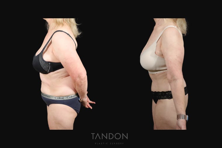 Abdominoplasty (Tummy Tuck) Before & After Gallery - Patient 217134 - Image 3