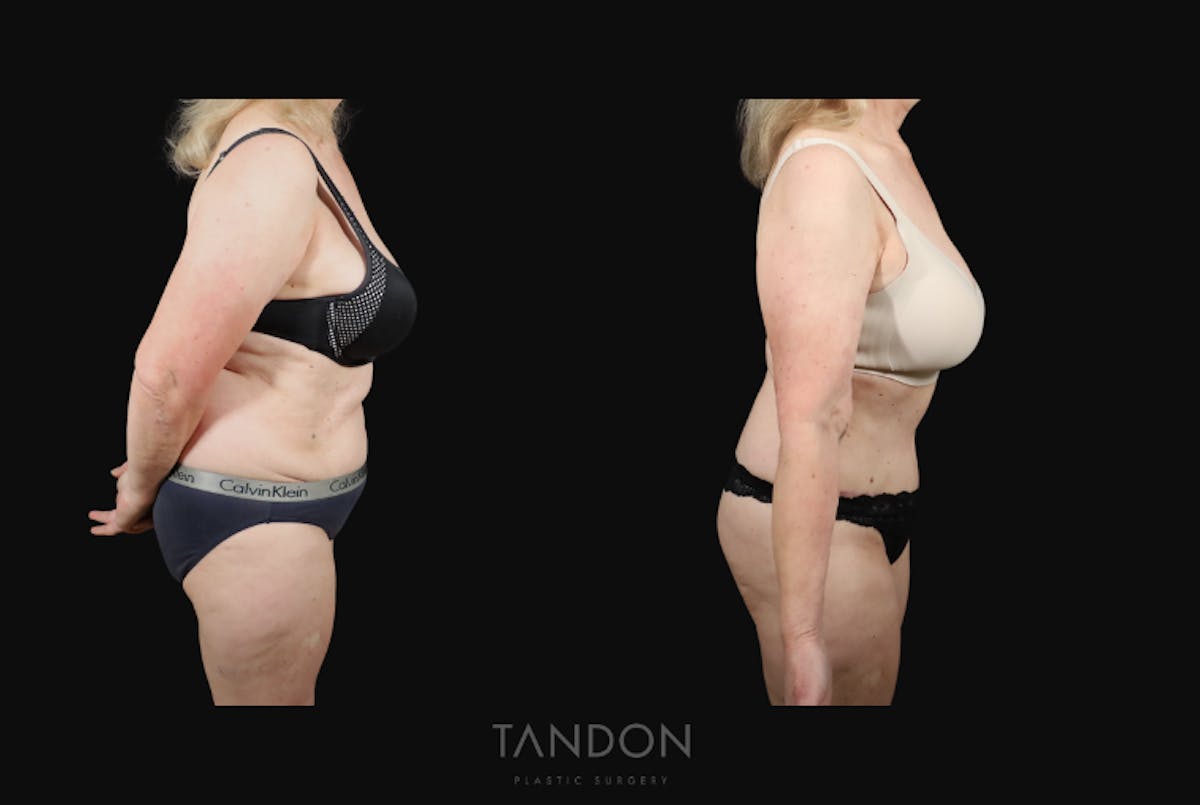 Abdominoplasty (Tummy Tuck) Before & After Gallery - Patient 217134 - Image 4