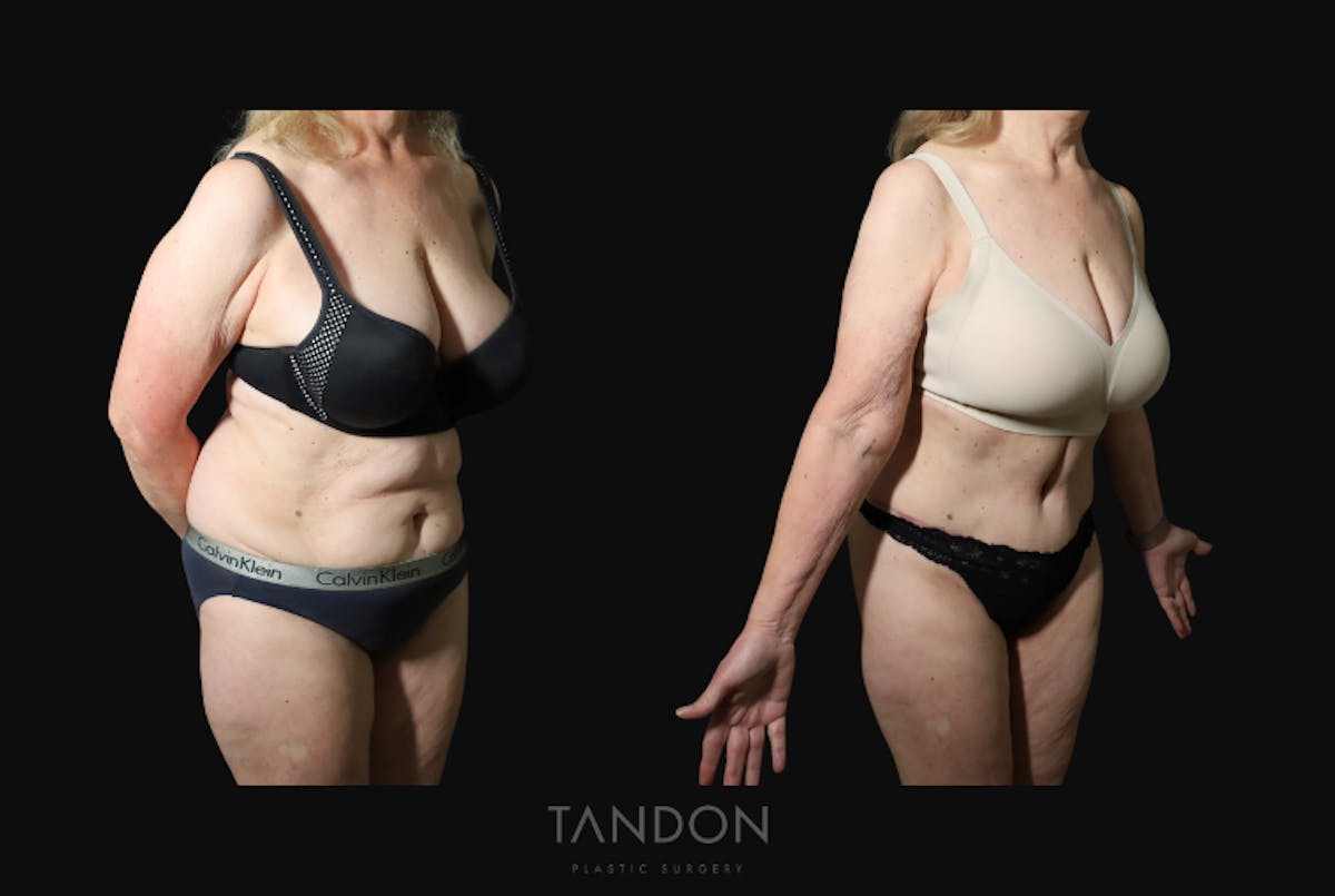 Abdominoplasty (Tummy Tuck) Before & After Gallery - Patient 217134 - Image 5
