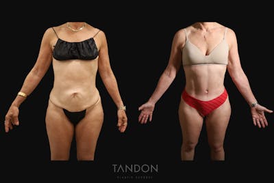 Abdominoplasty (Tummy Tuck) Before & After Gallery - Patient 338947 - Image 1