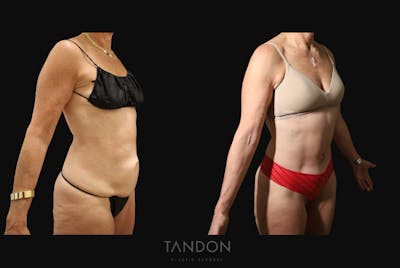 Abdominoplasty (Tummy Tuck) Before & After Gallery - Patient 338947 - Image 2