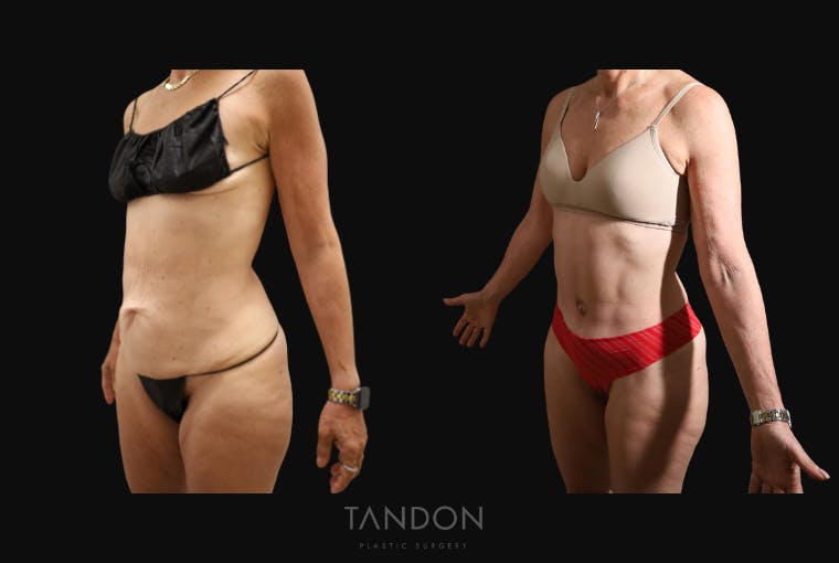 Abdominoplasty (Tummy Tuck) Before & After Gallery - Patient 338947 - Image 3