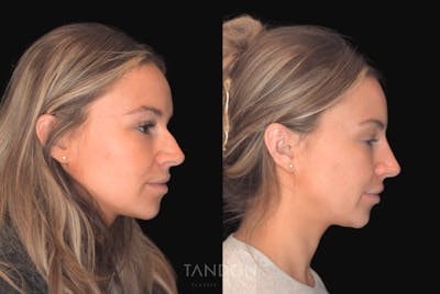 Non Surgical Rhinoplasty Before & After Gallery - Patient 263491 - Image 1