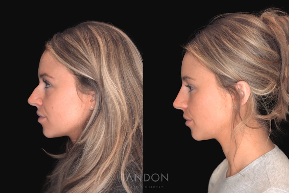 Non Surgical Rhinoplasty Before & After Gallery - Patient 263491 - Image 2
