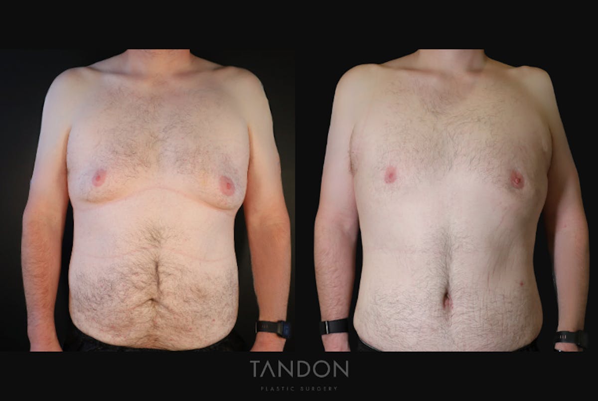 Male Breast Reduction (Gynecomastia) Before & After Gallery - Patient 303259 - Image 1