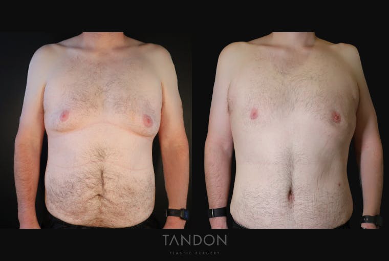 Male Breast Reduction (Gynecomastia) Before & After Gallery - Patient 303259 - Image 1