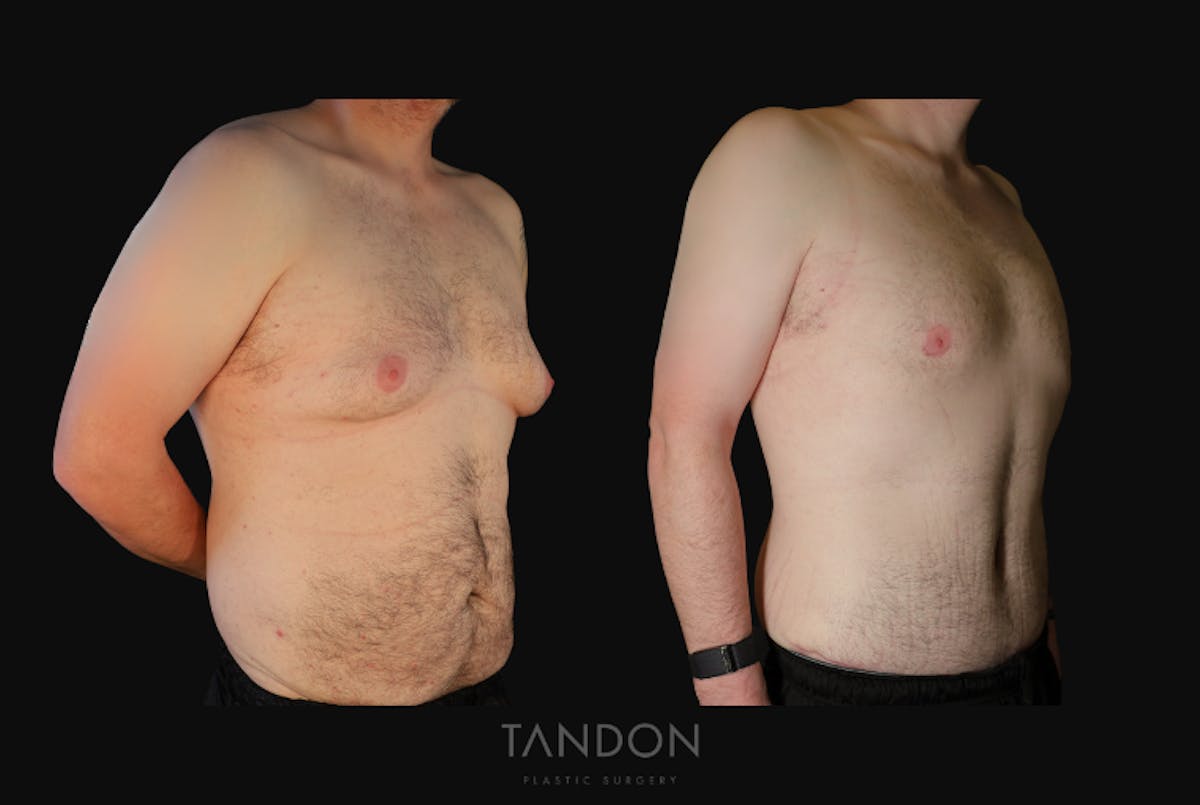 Male Breast Reduction (Gynecomastia) Before & After Gallery - Patient 303259 - Image 2