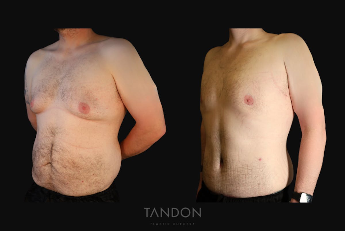 Male Breast Reduction (Gynecomastia) Before & After Gallery - Patient 303259 - Image 3