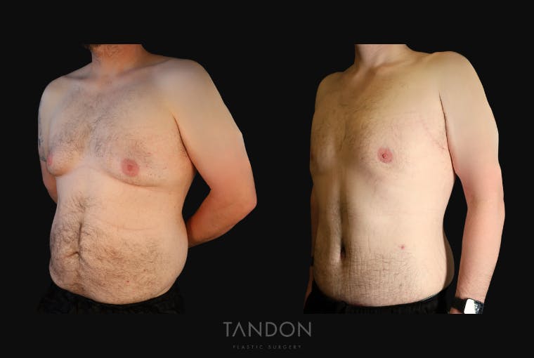 Male Breast Reduction (Gynecomastia) Before & After Gallery - Patient 303259 - Image 3