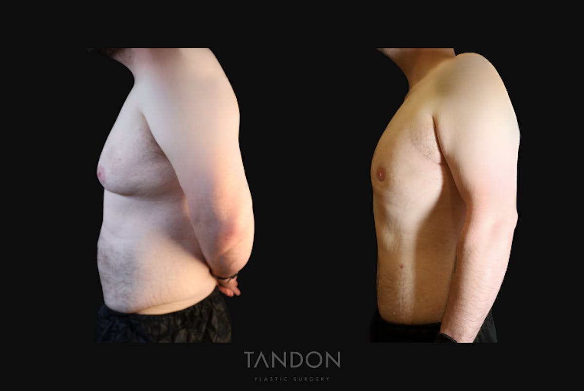 Male Breast Reduction (Gynecomastia) Before & After Gallery - Patient 303259 - Image 4