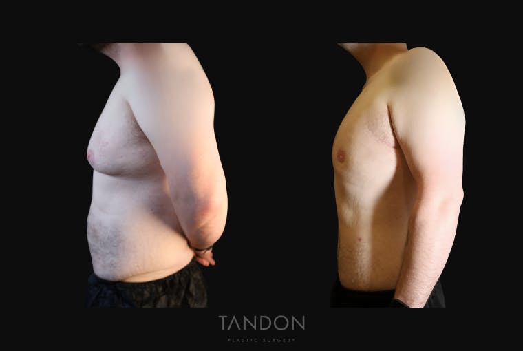 Male Breast Reduction (Gynecomastia) Before & After Gallery - Patient 303259 - Image 4
