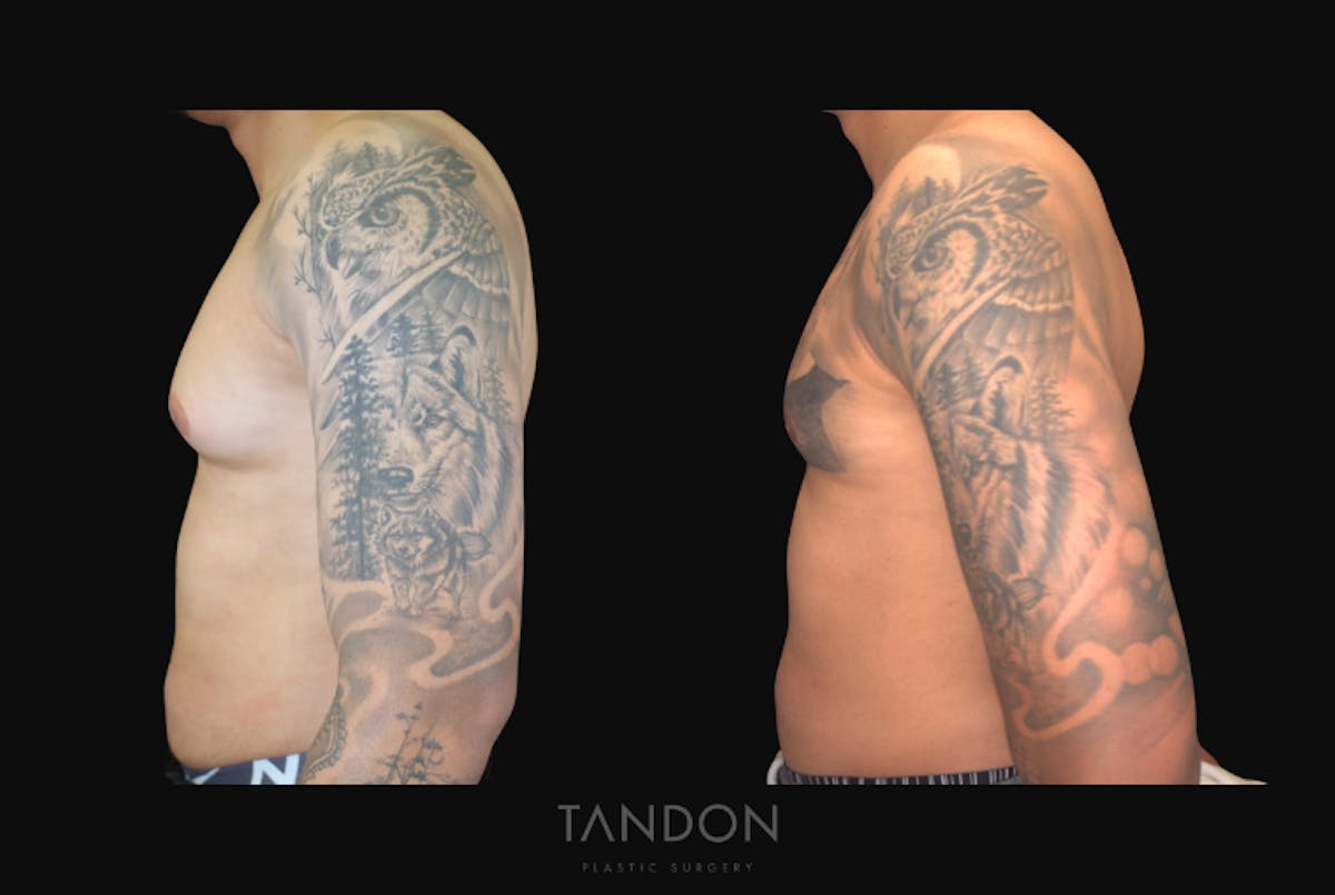 Male Breast Reduction (Gynecomastia) Before & After Gallery - Patient 957231 - Image 4