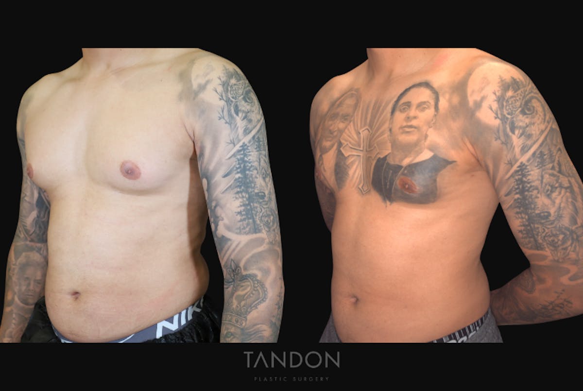 Male Breast Reduction (Gynecomastia) Before & After Gallery - Patient 957231 - Image 5