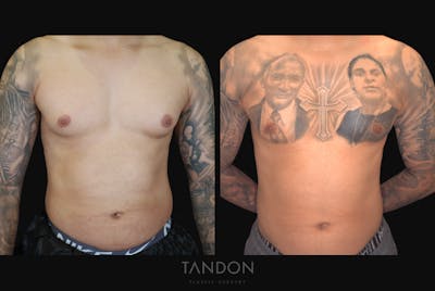 Male Breast Reduction (Gynecomastia) Before & After Gallery - Patient 957231 - Image 1