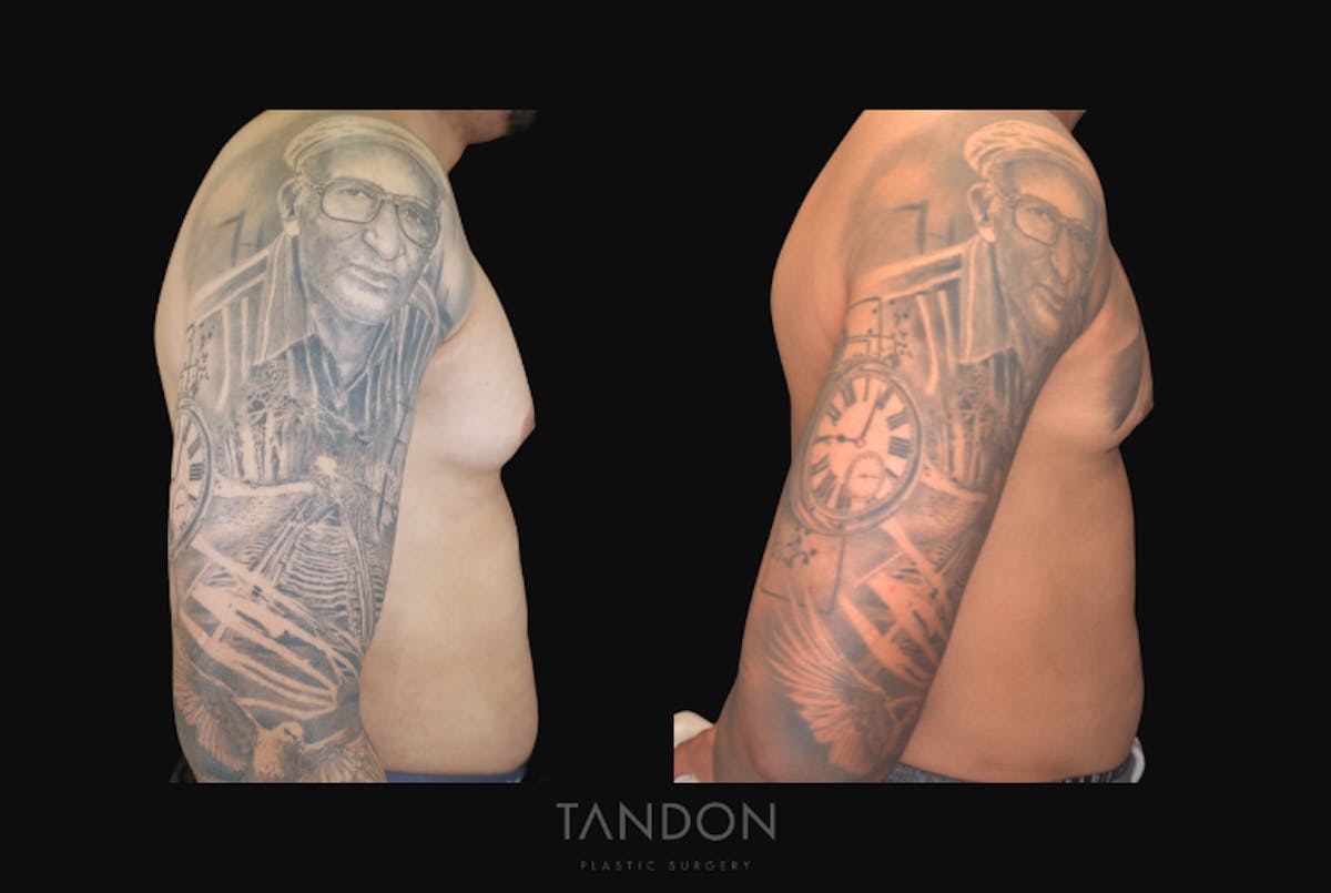 Male Breast Reduction (Gynecomastia) Before & After Gallery - Patient 957231 - Image 3