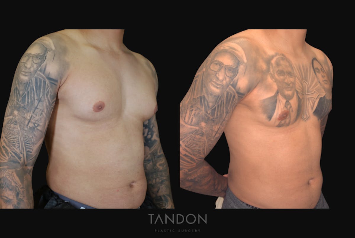 Male Breast Reduction (Gynecomastia) Before & After Gallery - Patient 957231 - Image 2