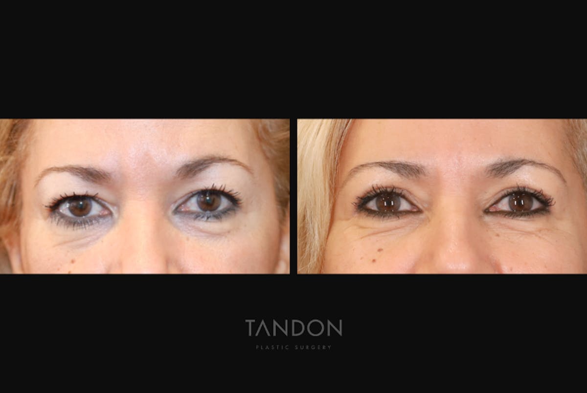 Blepharoplasty Before & After Gallery - Patient 232741 - Image 1