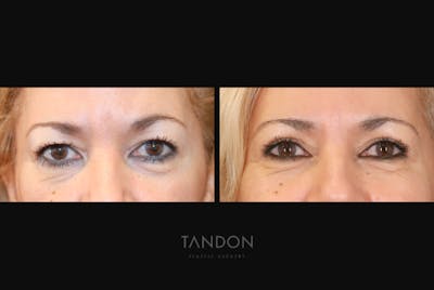 Blepharoplasty Before & After Gallery - Patient 232741 - Image 1