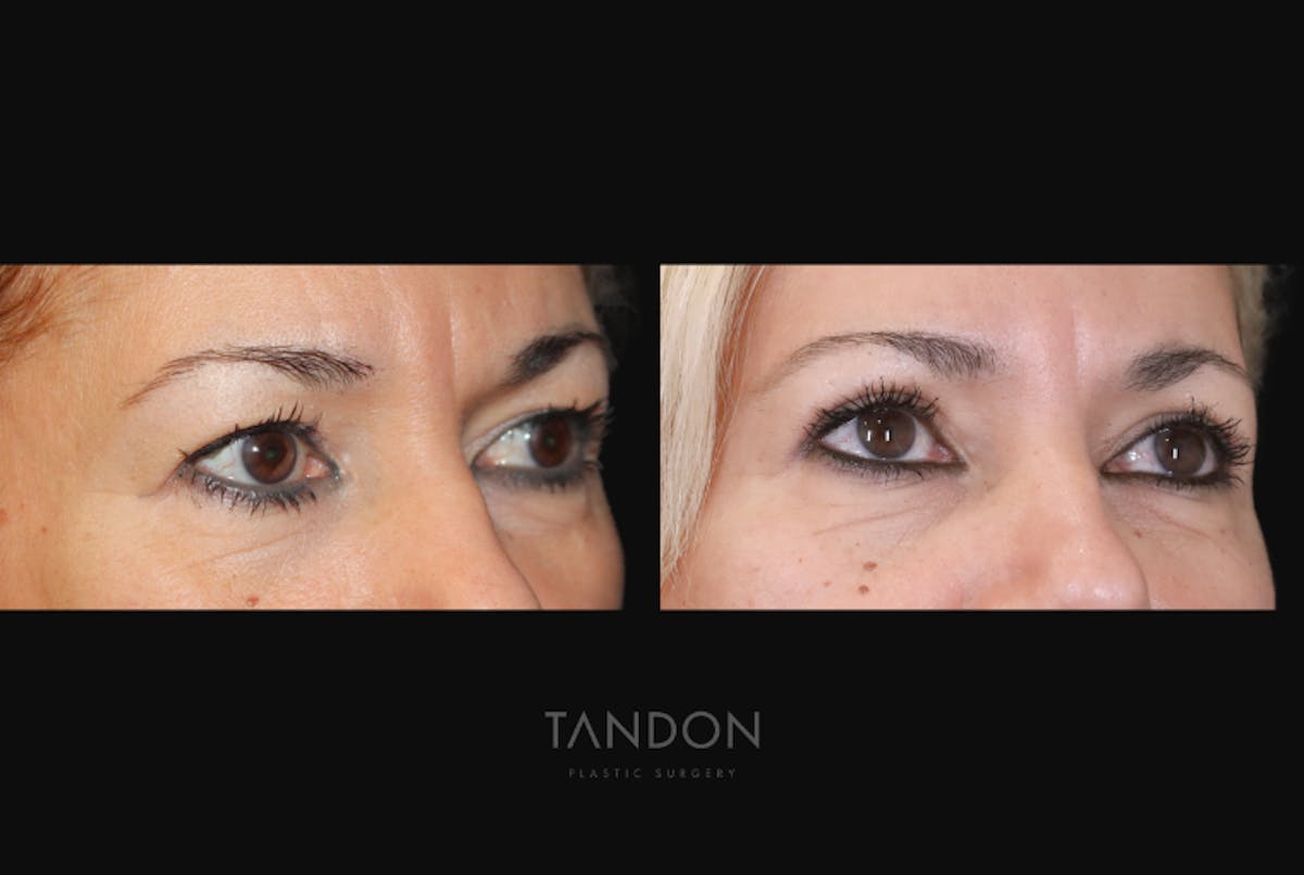 Blepharoplasty Before & After Gallery - Patient 232741 - Image 2