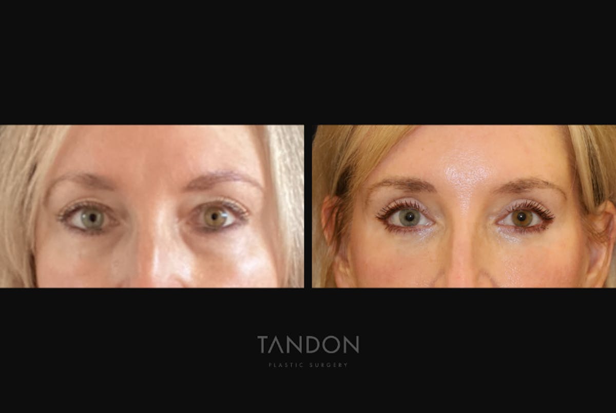 Blepharoplasty Before & After Gallery - Patient 283919 - Image 1
