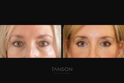 Blepharoplasty Before & After Gallery - Patient 283919 - Image 1