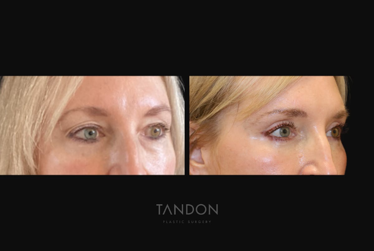 Blepharoplasty Before & After Gallery - Patient 283919 - Image 3