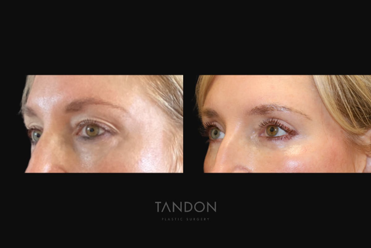 Blepharoplasty Before & After Gallery - Patient 283919 - Image 2