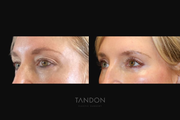 Blepharoplasty Before & After Gallery - Patient 283919 - Image 2