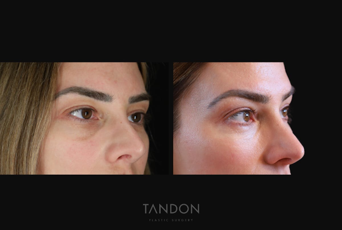 Blepharoplasty Before & After Gallery - Patient 168462 - Image 3