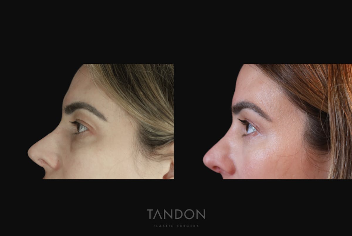 Blepharoplasty Before & After Gallery - Patient 168462 - Image 4