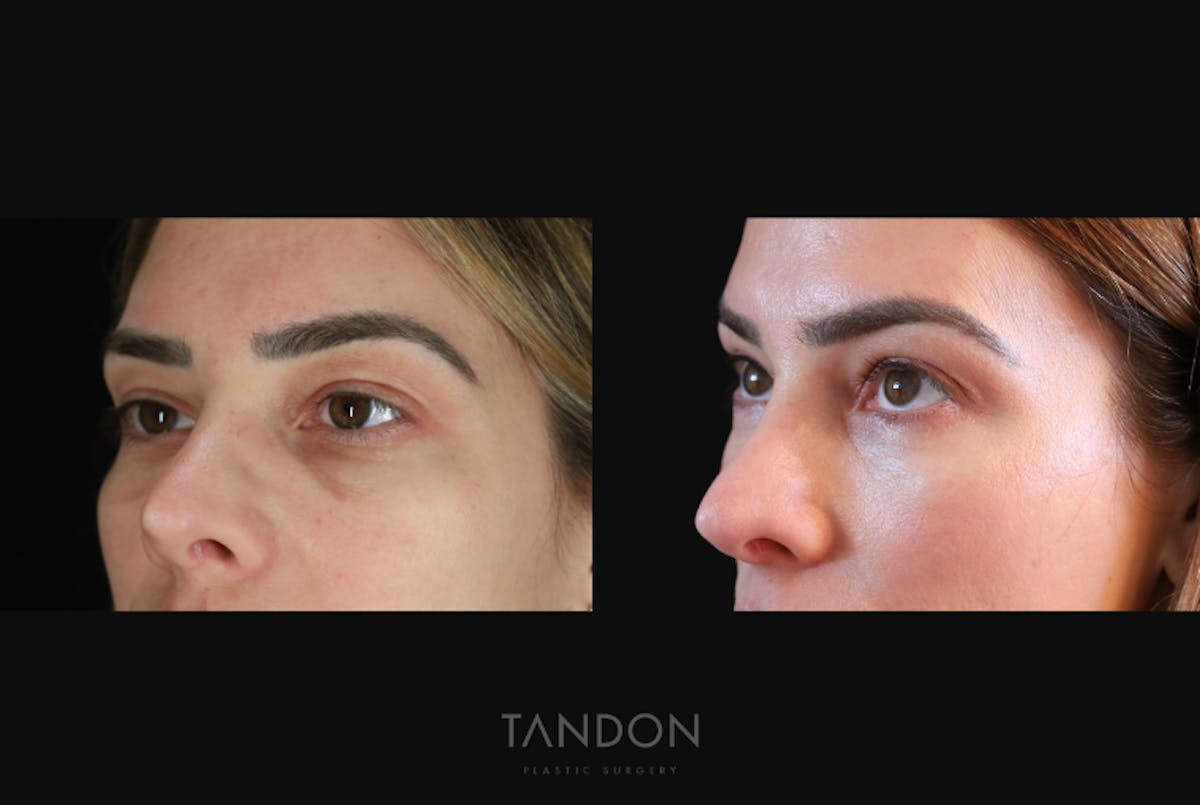 Blepharoplasty Before & After Gallery - Patient 168462 - Image 2