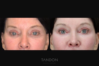 Blepharoplasty Before & After Gallery - Patient 333313 - Image 1