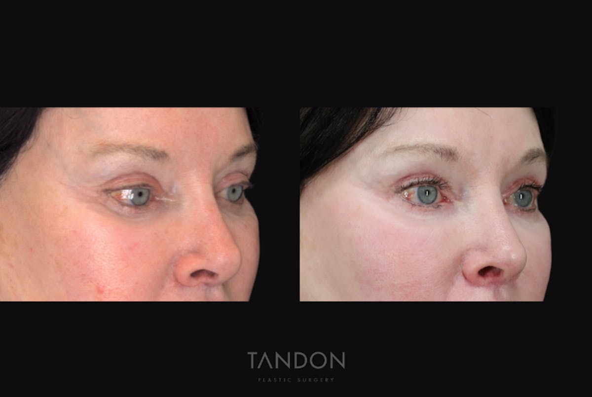 Blepharoplasty Before & After Gallery - Patient 333313 - Image 2