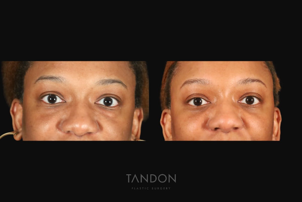 Blepharoplasty Before & After Gallery - Patient 318347 - Image 1