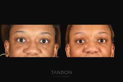 Blepharoplasty Before & After Gallery - Patient 318347 - Image 1