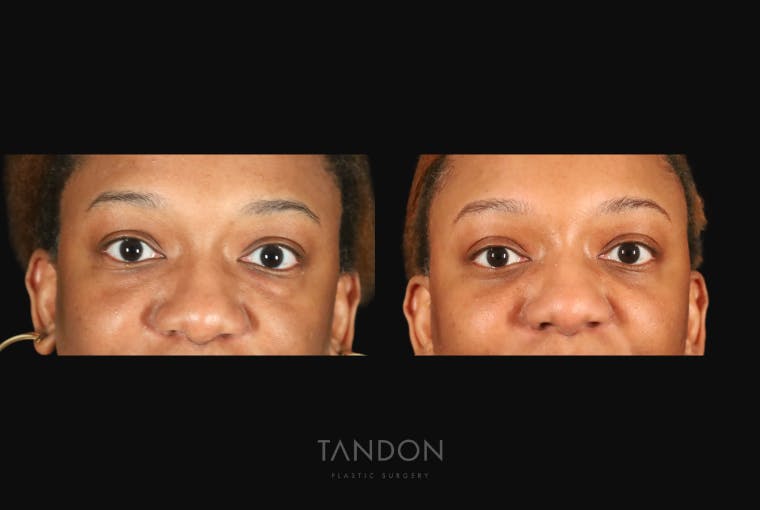 Blepharoplasty Before & After Gallery - Patient 318347 - Image 1