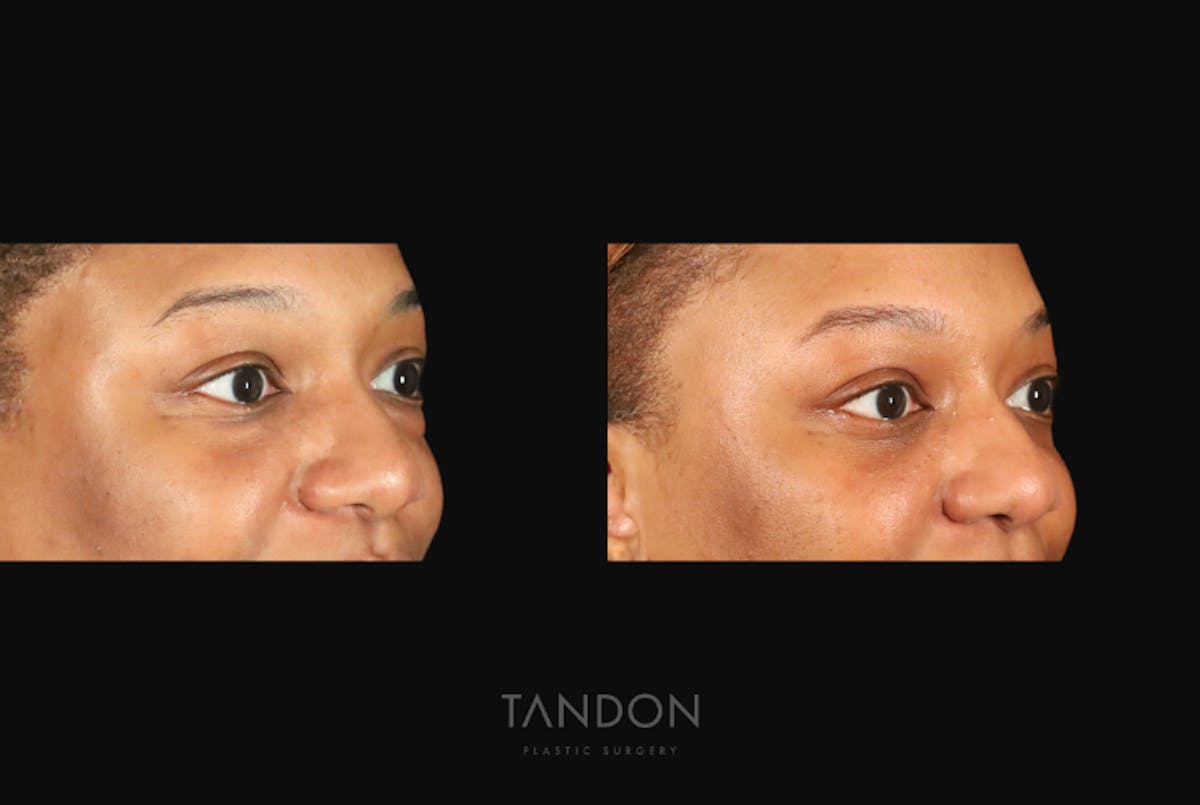 Blepharoplasty Before & After Gallery - Patient 318347 - Image 2