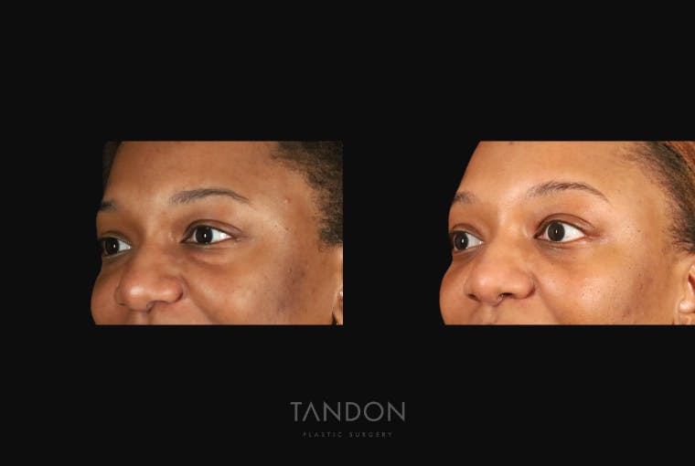 Blepharoplasty Before & After Gallery - Patient 318347 - Image 3