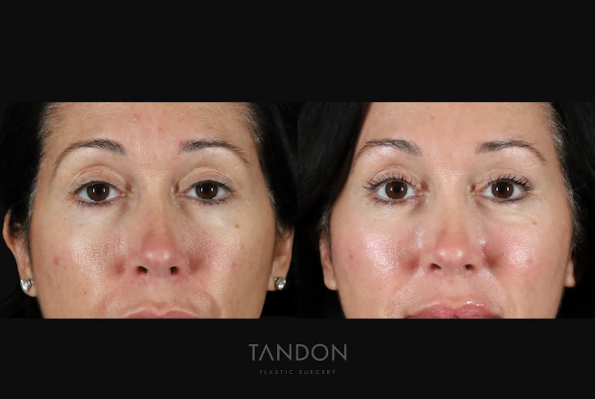 Brow Lift Before & After Gallery - Patient 579752 - Image 1
