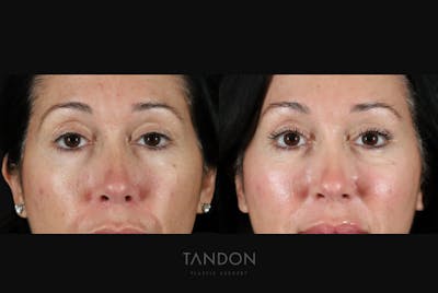 Blepharoplasty Before & After Gallery - Patient 272214 - Image 1