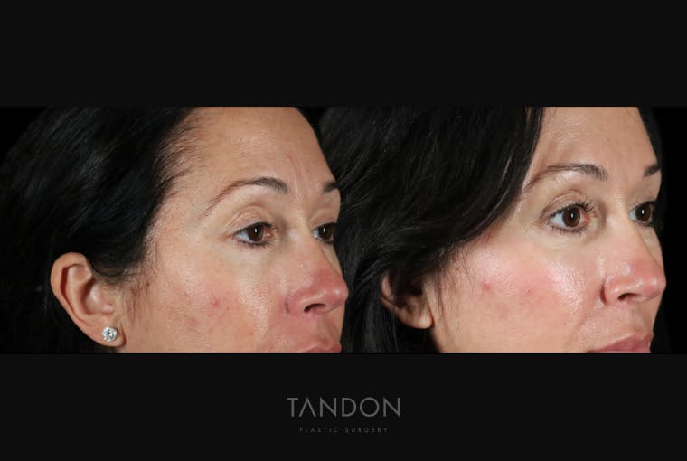 Brow Lift Before & After Gallery - Patient 579752 - Image 2