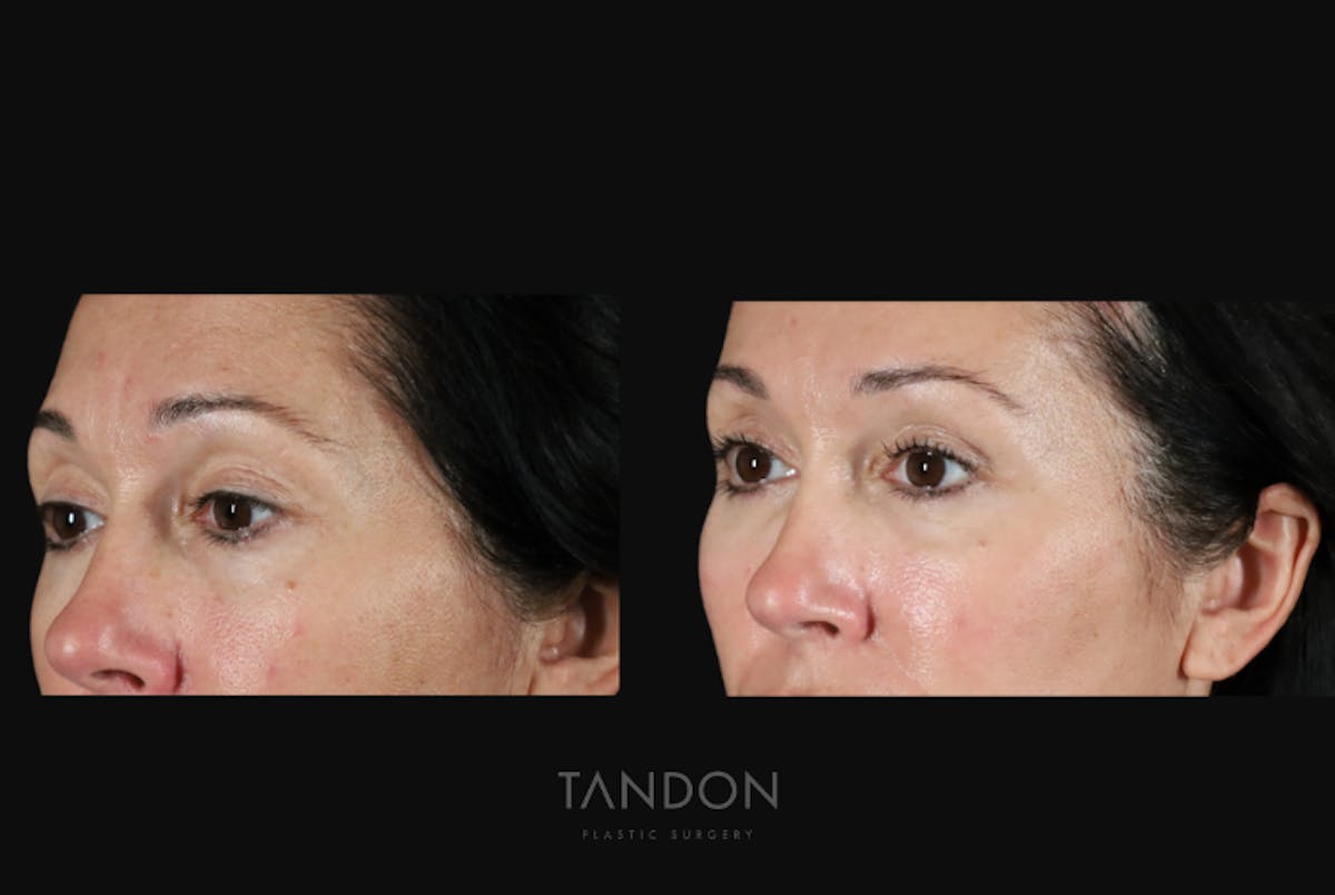 Brow Lift Before & After Gallery - Patient 579752 - Image 3