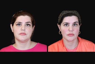 Buccal Fat Reduction Before & After Gallery - Patient 135838 - Image 1