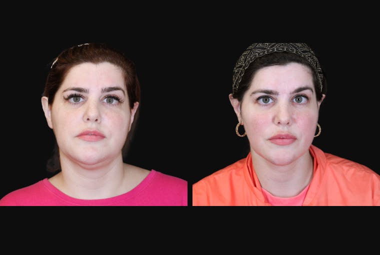 Buccal Fat Reduction Before & After Gallery - Patient 135838 - Image 1