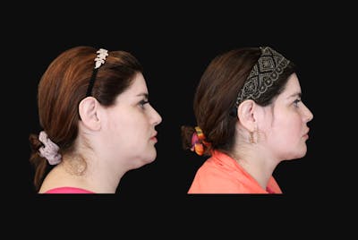 Neck Liposuction Before & After Gallery - Patient 260446 - Image 1