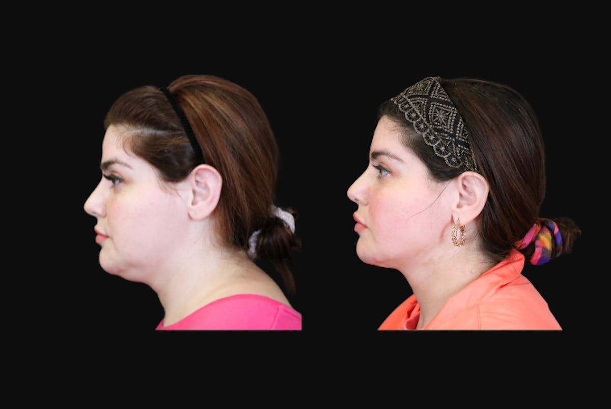 Buccal Fat Reduction Before & After Gallery - Patient 135838 - Image 5