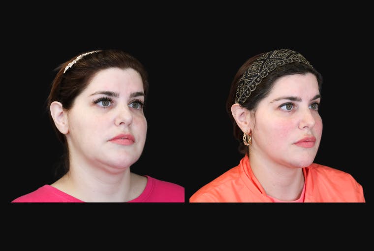 Buccal Fat Reduction Before & After Gallery - Patient 135838 - Image 3