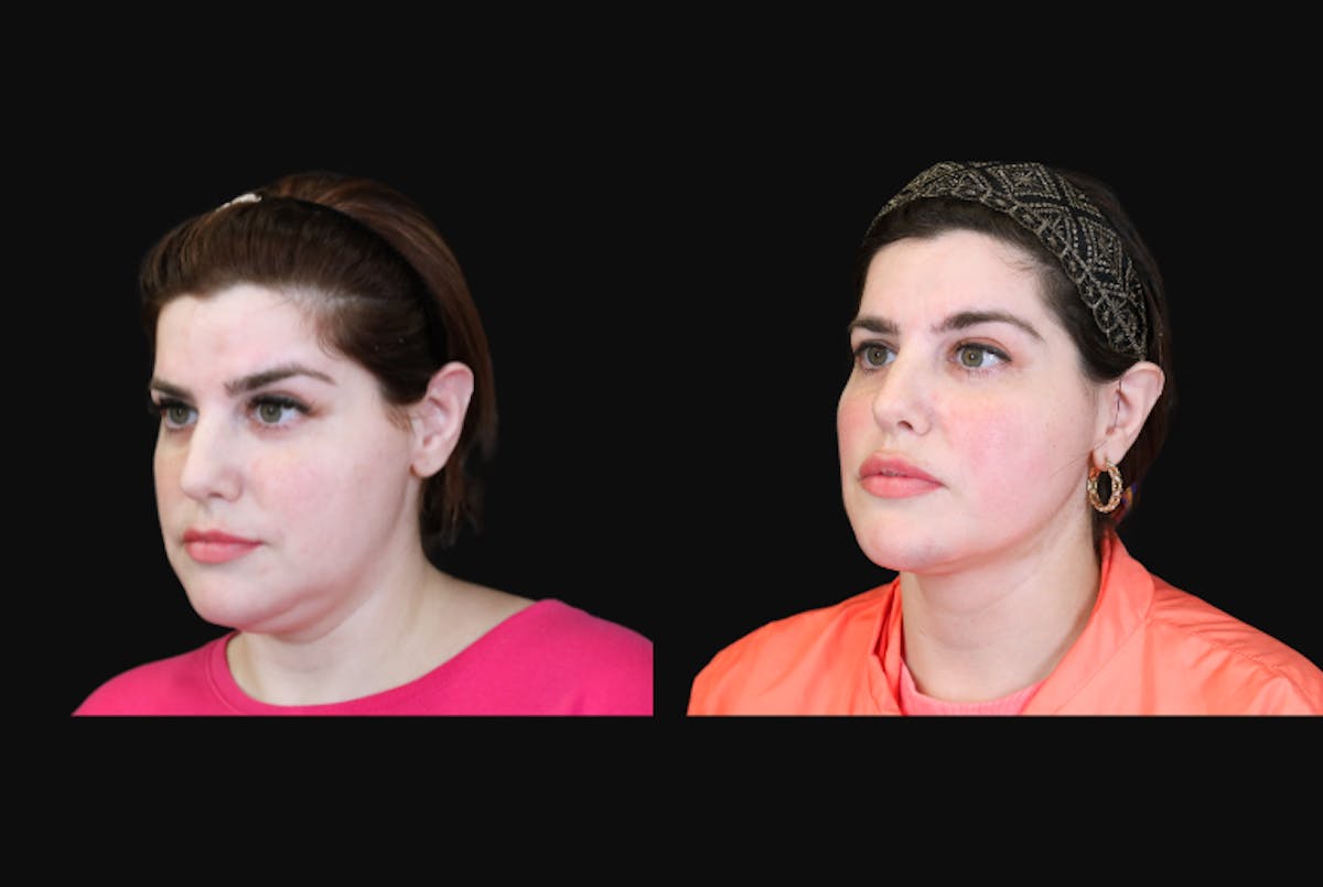 Buccal Fat Reduction Before & After Gallery - Patient 135838 - Image 4