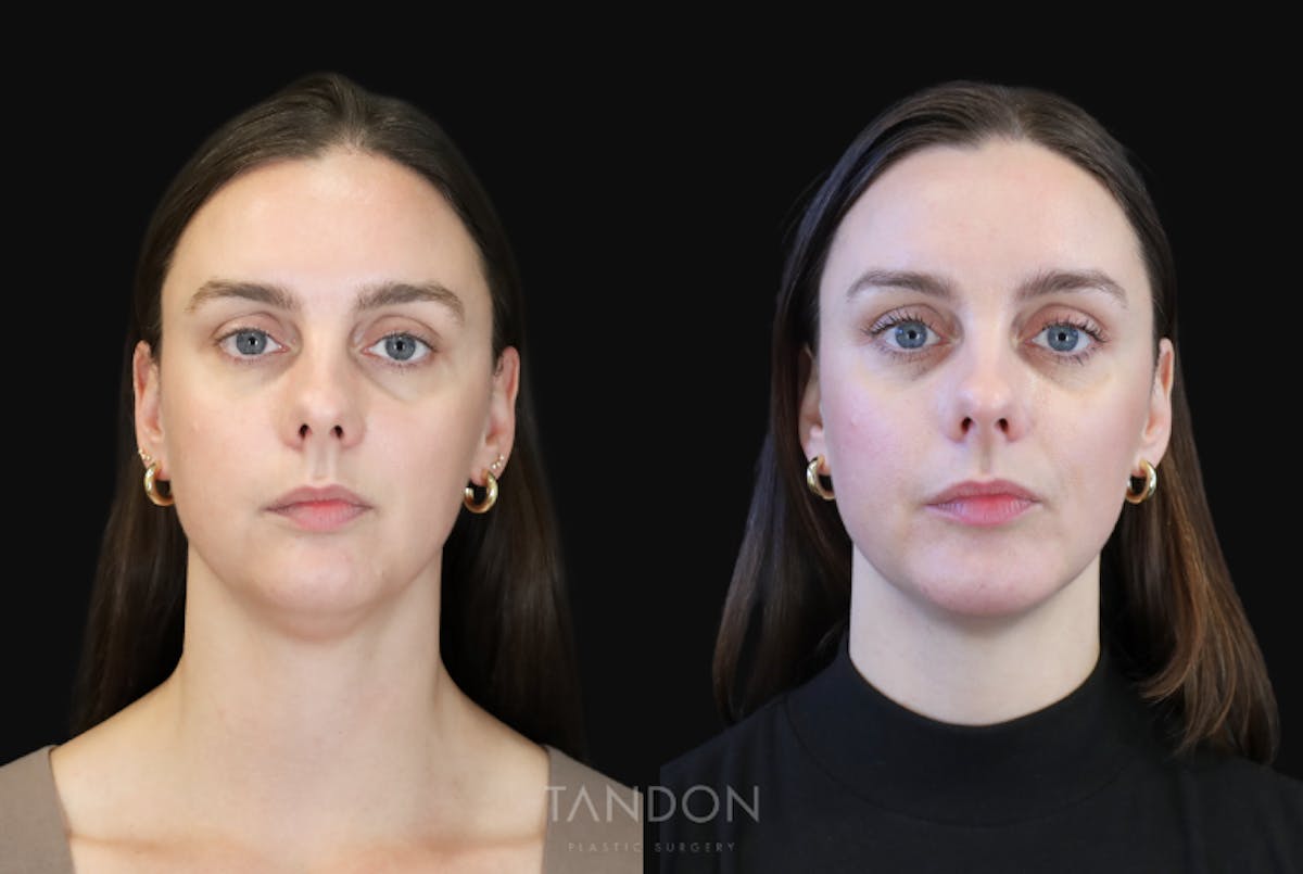 Neck Liposuction Before & After Gallery - Patient 320831 - Image 3