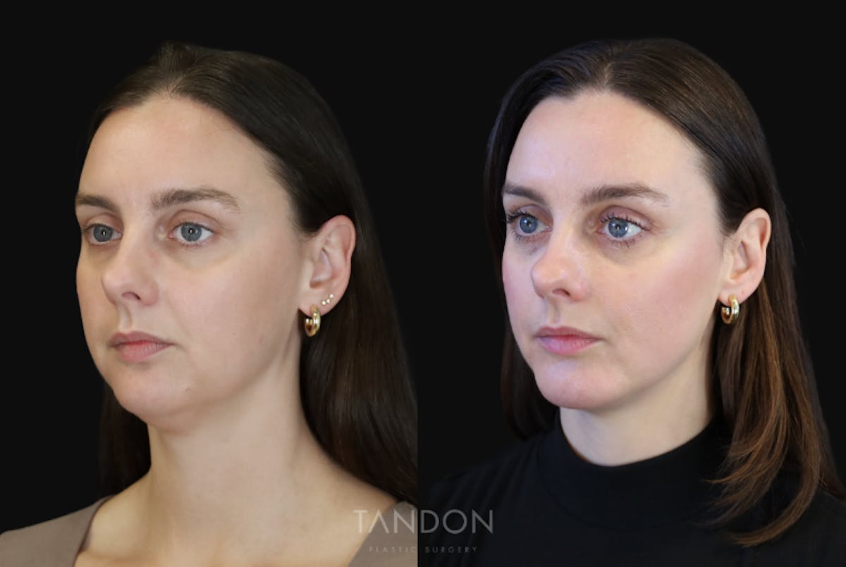Neck Liposuction Before & After Gallery - Patient 320831 - Image 2